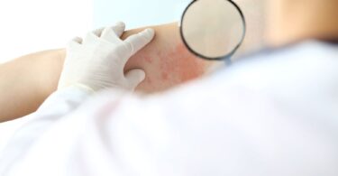 clinical trial data on inflammatory skin disease treatment