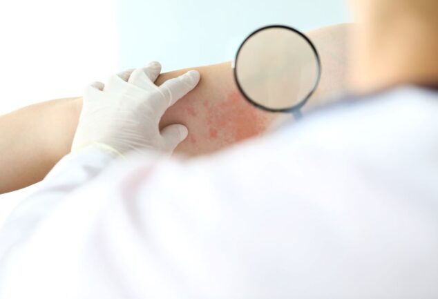 clinical trial data on inflammatory skin disease treatment