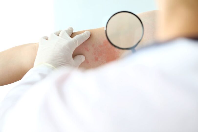 clinical trial data on inflammatory skin disease treatment