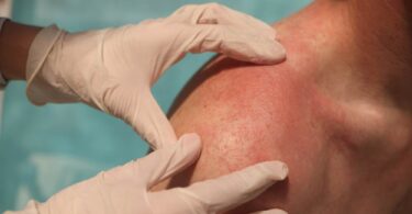 Briquilimab chronic spontaneous urticaria clinical examination