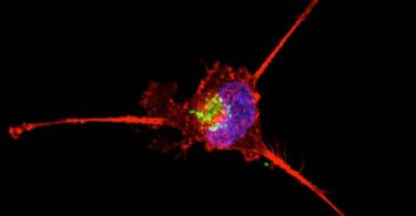 AI angiography systems for liver cancer embolization shown in cancer cell imaging