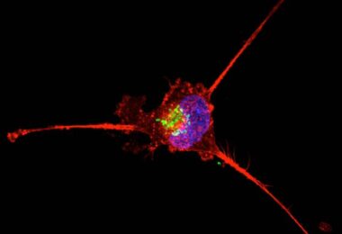 AI angiography systems for liver cancer embolization shown in cancer cell imaging