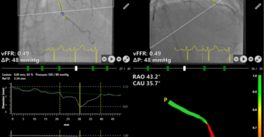 Siemens Healthineers FAST III vFFR coronary artery imaging analysis