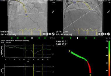 Siemens Healthineers FAST III vFFR coronary artery imaging analysis