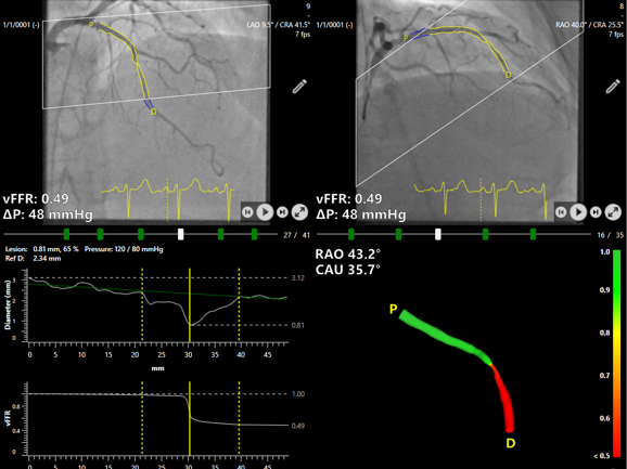 Siemens Healthineers FAST III vFFR coronary artery imaging analysis