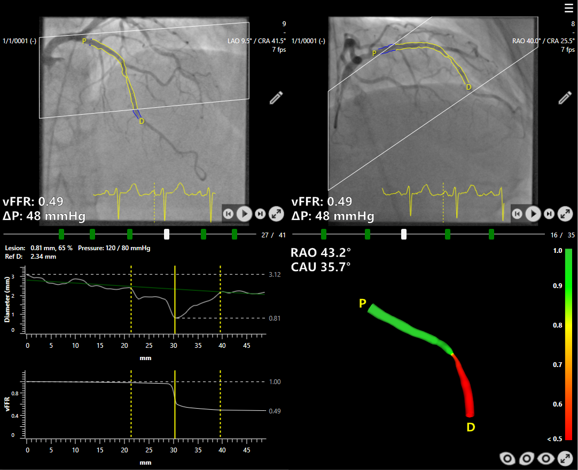 Siemens Healthineers FAST III vFFR coronary artery imaging analysis